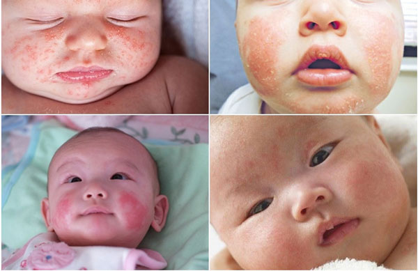 Dấu hiệu trẻ sơ sinh bị chàm