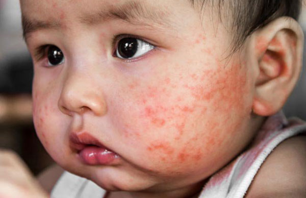 Bé bị nổi mẩn đỏ khắp người và ngứa