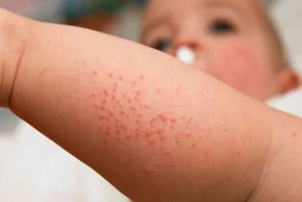 Nổi mẩn đỏ khắp người không sốt không ngứa