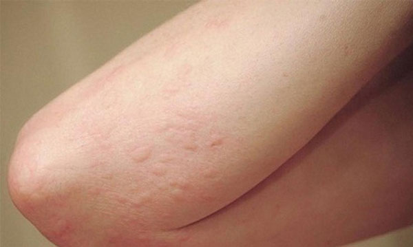 nổi mẩn đỏ khắp người không sốt không ngứa