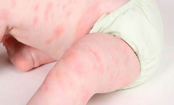 Nổi mẩn đỏ khắp người không sốt không ngứa