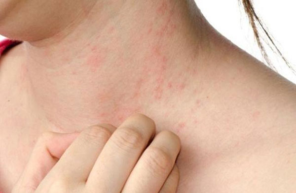 Dấu hiệu nổi mẩn ngứa khắp người muỗi đốt