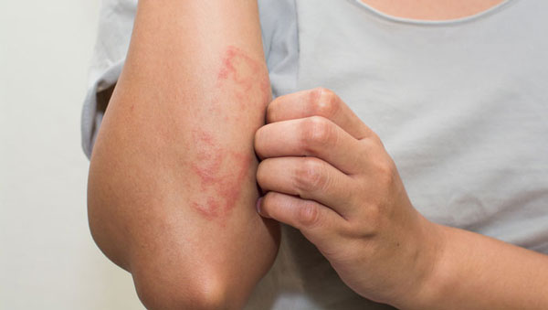 Dấu hiệu nổi mẩn ngứa khắp người như muỗi đốt
