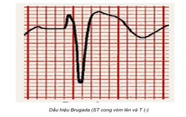 Hội chứng Brugada - Căn bệnh gây ra cái chết đột ngột với tỷ lệ cao
