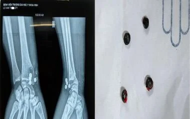 PHẪU THUẬT VỠ XƯƠNG QUAY DO ĐẠN BẮN