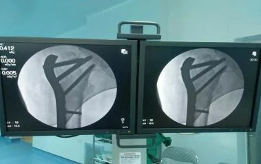 KẾT HỢP GÃY XƯƠNG ĐÙI BẰNG NẸP KHOÁ TRÊN MÀN TĂNG SÁNG