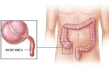 VIÊM PHÚC MẠC RUỘT THỪA