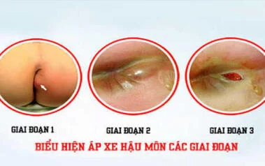 ĐAU ĐỚN VÀ KHỔ SỞ VÌ "NHỌT" VÙNG HẬU MÔN