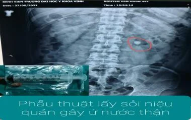 PHẪU THUẬT LẤY SỎI NIỆU QUẢN GÂY Ứ NƯỚC VÀ GIÃN ĐÀI BỂ THẬN