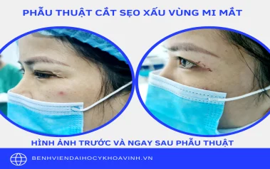Phẫu thuật xử lý sẹo xấu vùng mắt