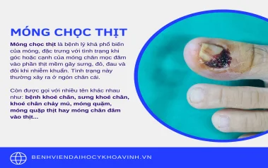 Móng chọc thịt - Nỗi đau nhức nhối của nhiều người!