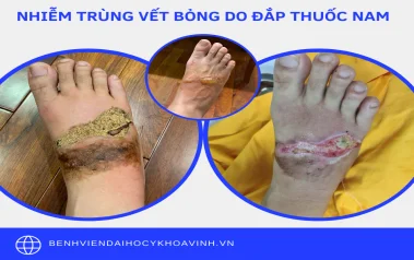 Cảnh báo biến chứng do đắp thuốc nam chữa Bỏng