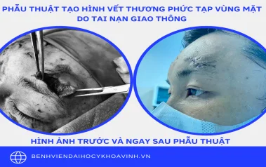 PHẪU THUẬT TẠO HÌNH CHO BỆNH NHÂN TAI NẠN GIAO THÔNG RÁCH DA VÙNG MẶT.