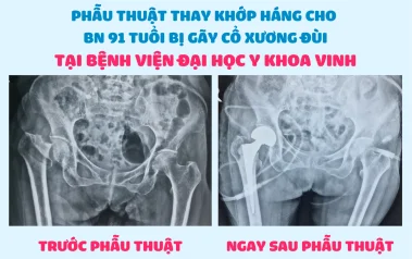 PHẪU THUẬT THAY KHỚP HÁNG CHO BỆNH NHÂN 91 TUỔI BỊ GÃY CỔ XƯƠNG ĐÙI TẠI BỆNH VIỆN ĐẠI HỌC Y KHOA VINH