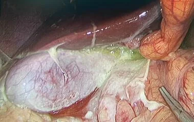 CẢNH BÁO THỦNG DẠ DÀY – TÁ TRÀNG Ở NGƯỜI TRẺ TUỔI DO THÓI QUEN SỐNG, SINH HOẠT THIẾU KHOA HỌC