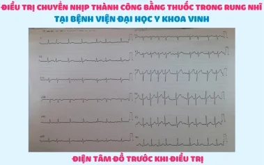 Điều trị chuyển nhịp thành công bằng thuốc trong rung nhĩ tại BV Đại Học Y khoa Vinh