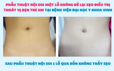 Thoát vị bẹn ở trẻ em: Biểu hiện, biến chứng thường gặp và phương pháp điều trị