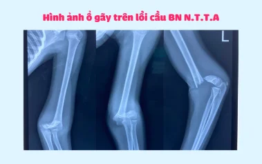 GÃY TRÊN LỒI CẦU XƯƠNG CÁNH TAY Ở TRẺ EM