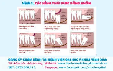Biến chứng do răng khôn mọc lệch và cách xử trí