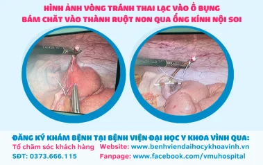 Vòng tránh thai "lạc trôi" vào ổ bụng xuyên thành ruột non