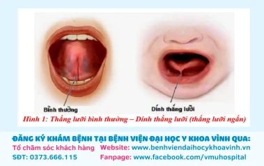 Dính thắng lưỡi - Những điều cần biết và phương pháp điều trị