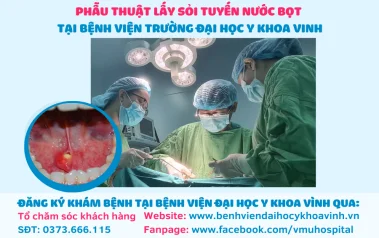 Viêm tuyến nước bọt dưới hàm do sỏi