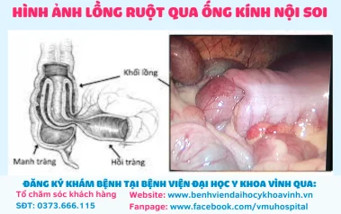 Kịp thời phẫu thuật cấp cứu cho trẻ bị lồng ruột cấp ngày thứ 3