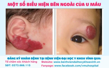 U MÁU VÙNG HÀM MẶT