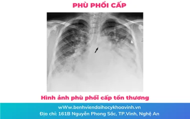 Phù phổi cấp