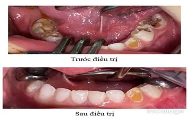 ĐIỀU TRỊ RĂNG BẰNG PHƯƠNG PHÁP GÂY MÊ CHO TRẺ EM