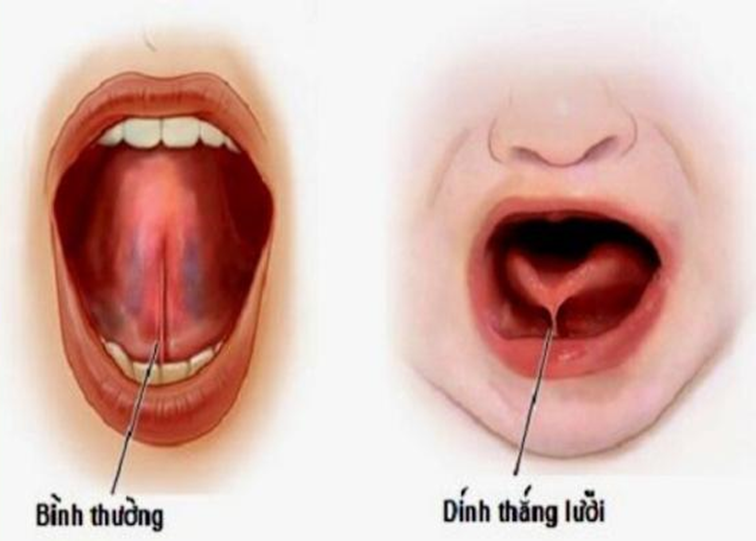 Dính thắng lưỡi