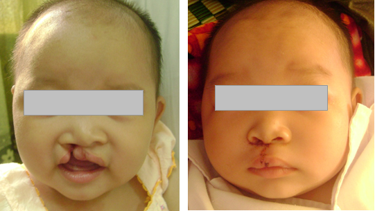 PHẪU THUẬT ĐIỀU TRỊ KHE HỞ MÔI VÀ BIẾN DẠNG MÔI – MŨI (SẸO XẤU MÔI – MŨI) SAU PHẪU THUẬT KHE HỞ MÔI