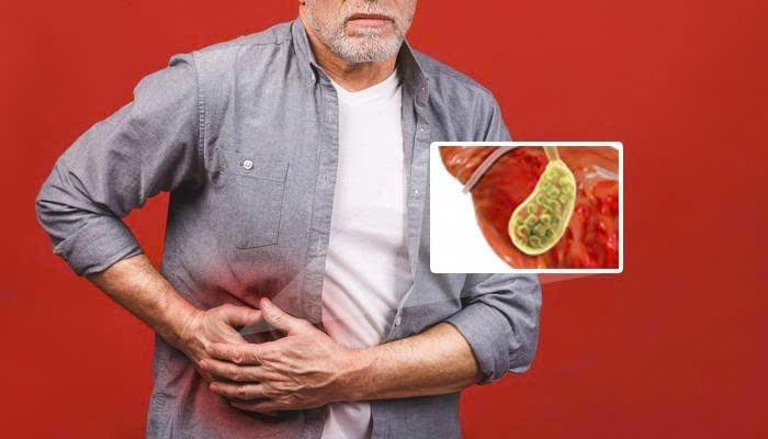 Phác đồ điều trị Bệnh Sỏi mật Phác đồ điều trị Bệnh Sỏi mật
