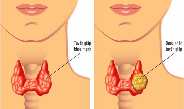 Tuyến giáp là một tuyến nội tiết quan trọng trong cơ thể.Một trong những nguyên nhân gây hiếm muộn ở phụ nữ được xác định là do bệnh lý của tuyến giáp.