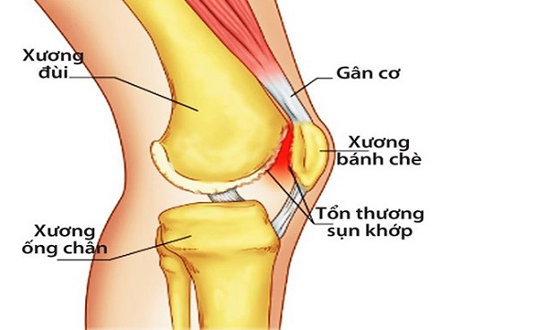 PHÒNG VÀ ĐIỀU TRỊ BỆNH THOÁI HÓA KHỚP GỐI