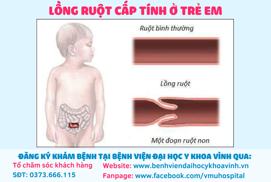 Lồng ruột cấp ở trẻ em: Triệu chứng, nguyên nhân, phương pháp chẩn đoán và điều trị