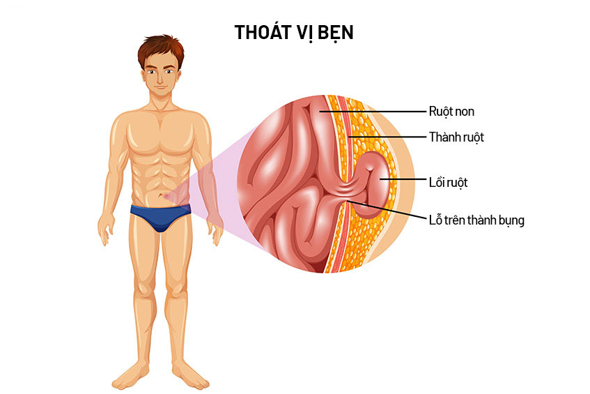 Thoát vị bẹn ở người lớn