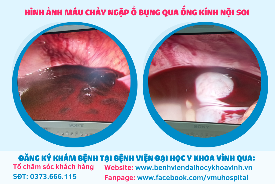 Cấp cứu thành công cho bệnh nhân thai ngoài tử cung vỡ đe dọa tính mạng Cấp cứu thành công cho bệnh nhân thai ngoài tử cung vỡ đe dọa tính mạng